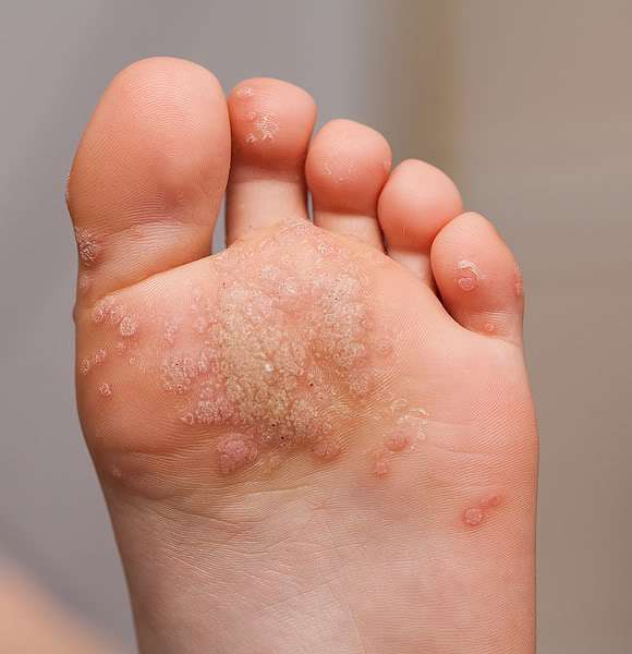 wart on foot reflexology