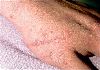 flat warts on hands