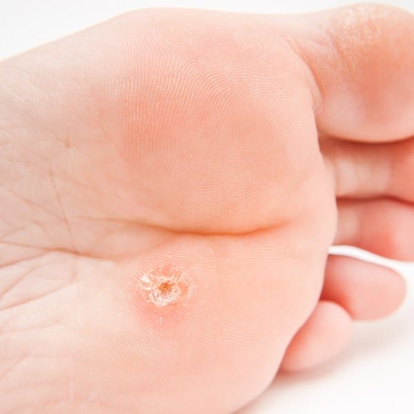 plantar wart on foot