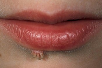 filiform wart on mouth