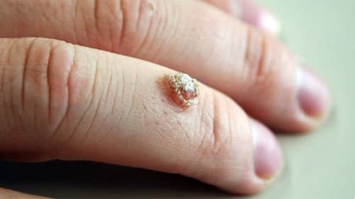 common wart on finger