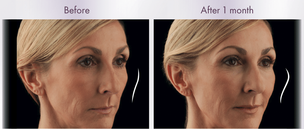 Voluma Before and After #1