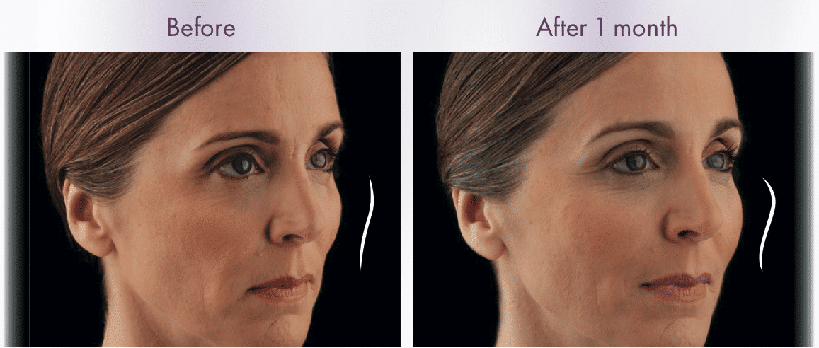 Voluma Before and After #2