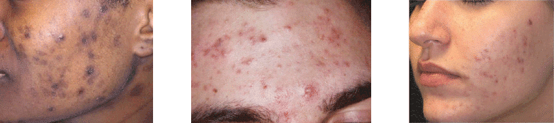 discolored acne scarring