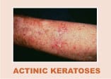 example of actinic keratosis