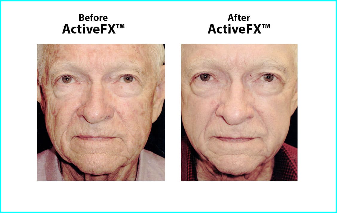 Before and After ActiveFX Treatement #1