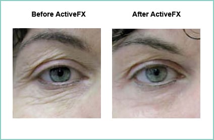 Before and After ActiveFX Treatement #2