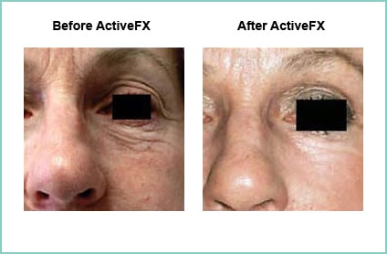 Before and After ActiveFX Treatement #3