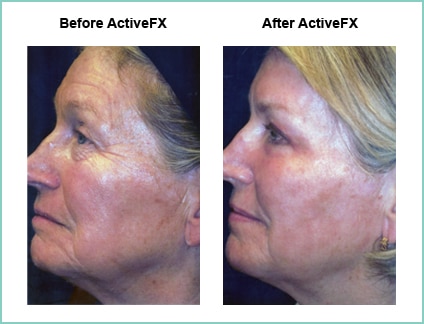 Before and After ActiveFX Treatement #4