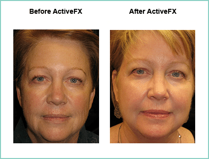 Before and After ActiveFX Treatement #5
