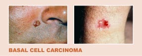 examples of Basal Cell Carcinoma