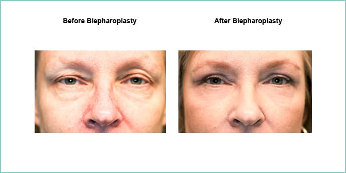 before and after blepharoplasty #4