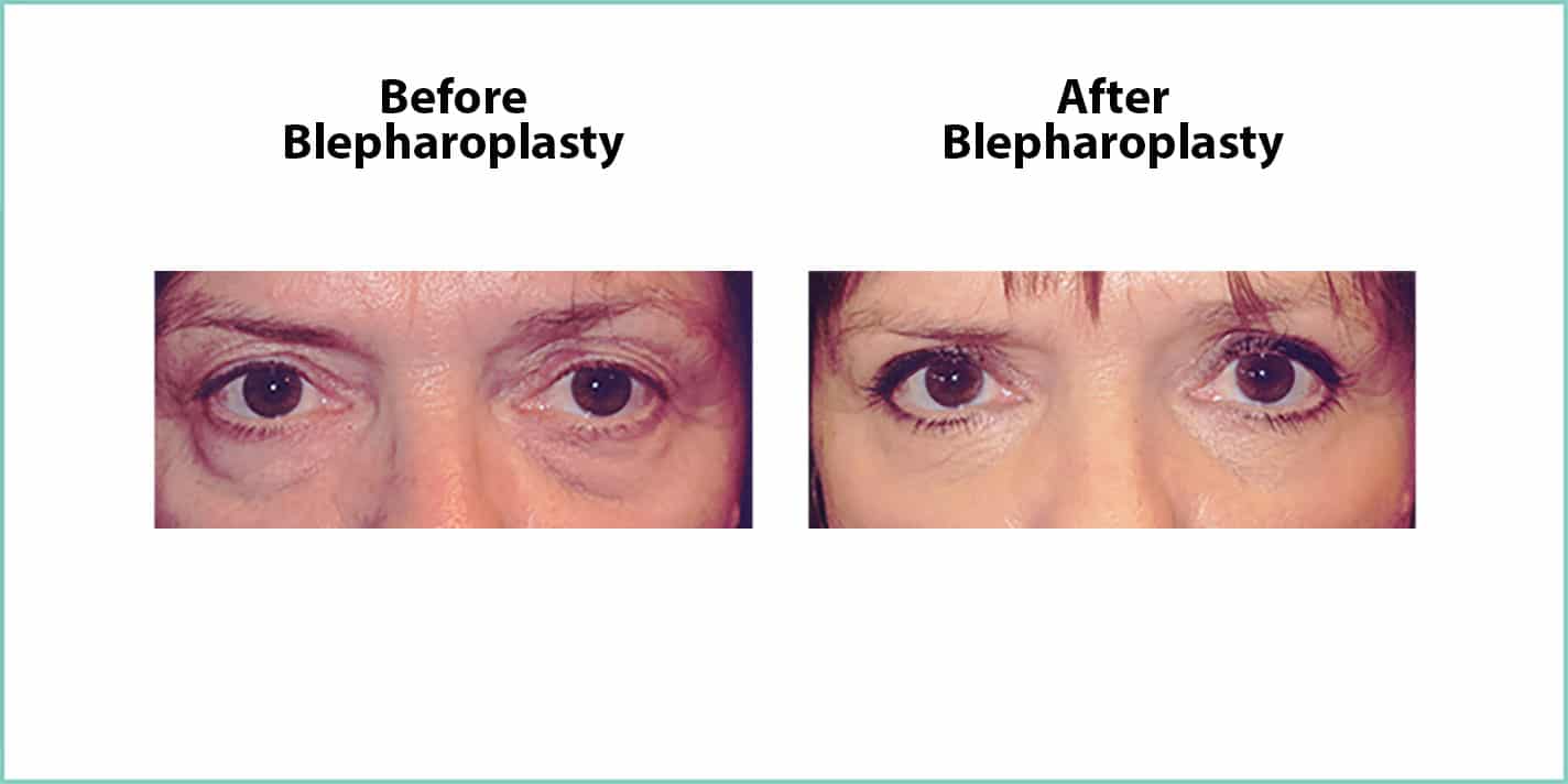 Blepharoplasty (Eyelid) Surgery Austin, Texas CTD