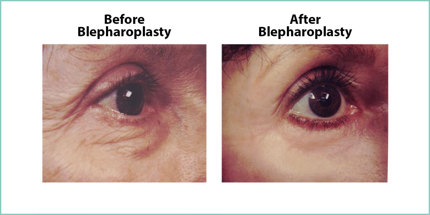Blepharoplasty (Eyelid) Surgery Austin, Texas CTD