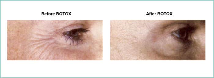 BOTOX before and after 1