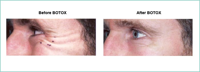 BOTOX before and after 2