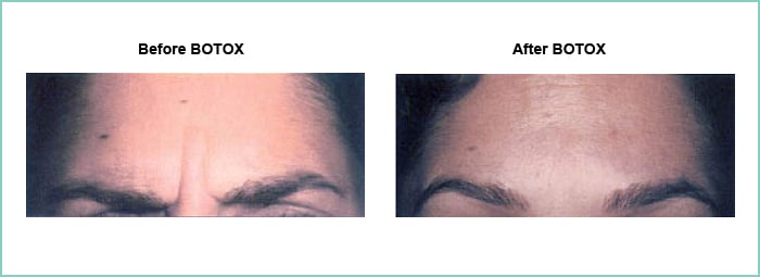 BOTOX before and after 3