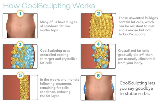 How CoolSculpting Work: 1. Many of us have bulges of stubbord fat like muffin tops. 2. Those unwanted bulges contain fat cells, which can be resistant to diet and excersize but not to CoolSculpting. 3. CoolSculpting uses controlled cooling to target and crystallize fat cells. 4. Crystallized fat cells gradually die off, then are naturally eliminated from the body. 5. In the week and month following treatment, remaining fat cells condense, reducing the fat layer. 6. CoolSculpting lets you say goodbye to stubborn fat.