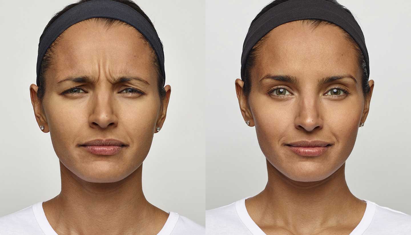 Dysport before and after 1