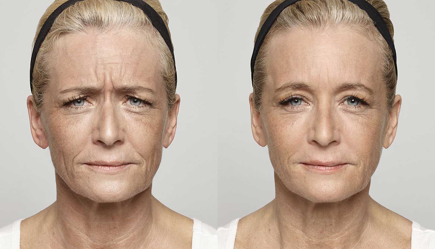 Dysport before and after 1