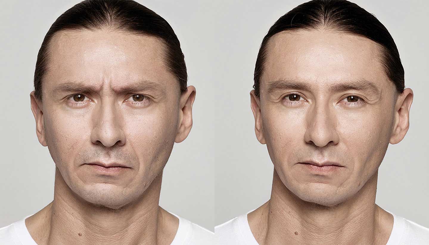 Dysport before and after 1