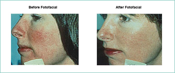 fotofacial before and after