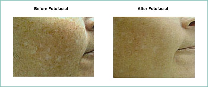 fotofacial before and after