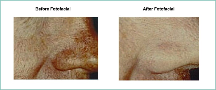 fotofacial before and after