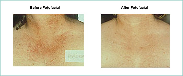 fotofacial before and after