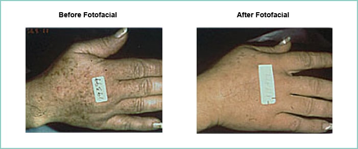 fotofacial before and after