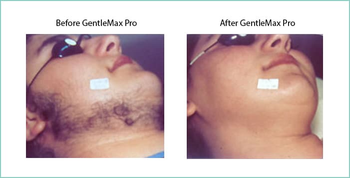 Laser Hair Removal Austin, Texas | Central Texas Dermatology