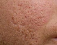 ice pick acne scarring