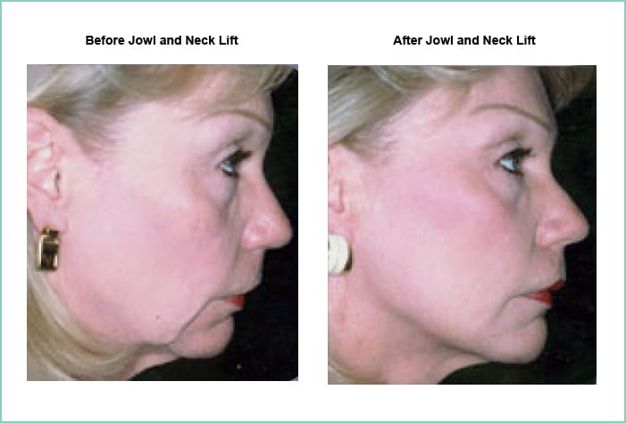 neck lift austin jowl reduction westlake lower face lift