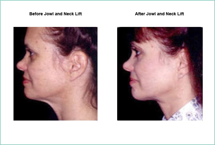neck lift austin jowl reduction westlake lower face lift