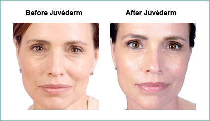 Juvederm Before and Asfter #1