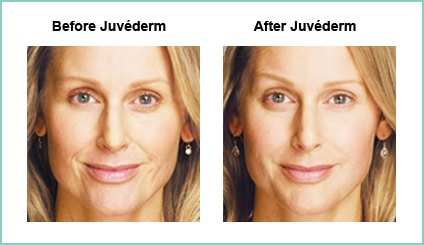 Juvederm Before and Asfter #2