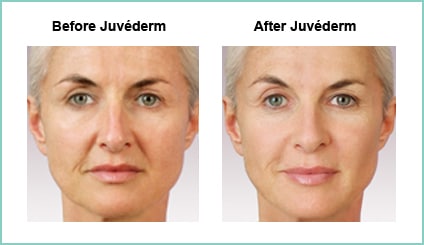Juvederm Before and Asfter #3