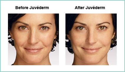 Juvederm Before and Asfter #4