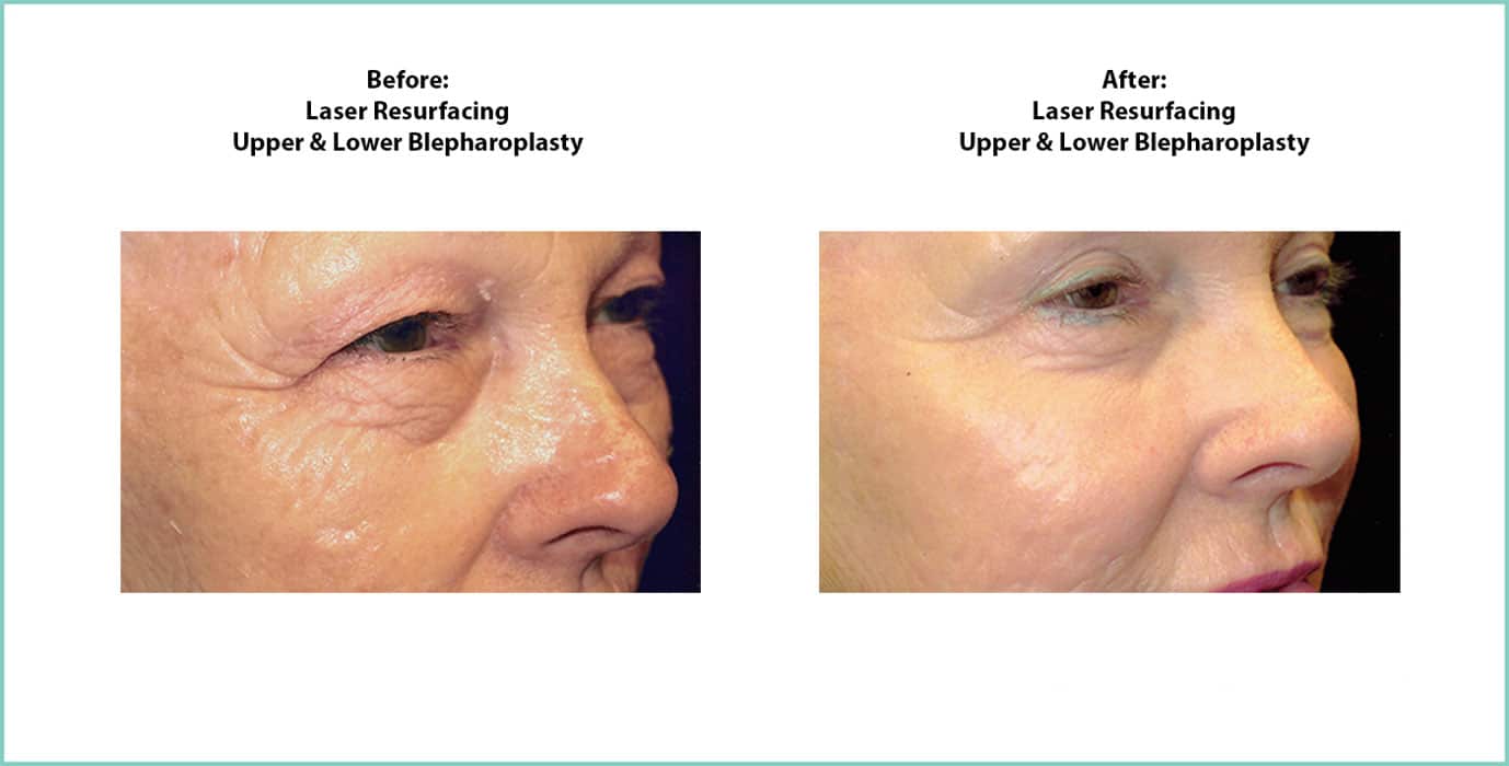 Laser Resurfacing Before and After Shot #1