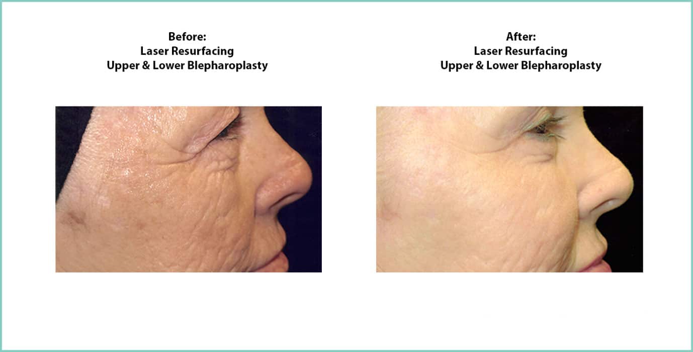 Laser Resurfacing Before and After Shot #2