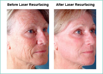 Laser Resurfacing Before and After Shot #6