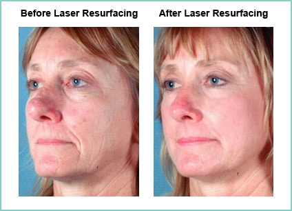 Laser Resurfacing Before and After Shot #7