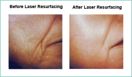 Laser Resurfacing Before and After Shot #8