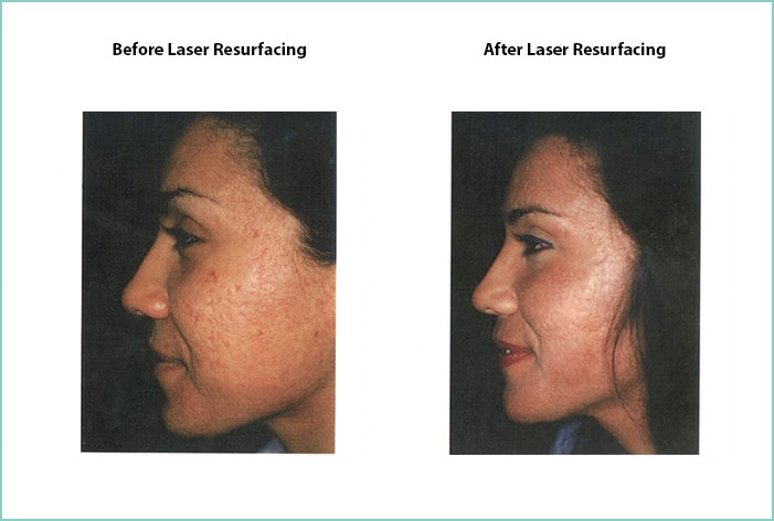 Laser Resurfacing Before and After Shot #9