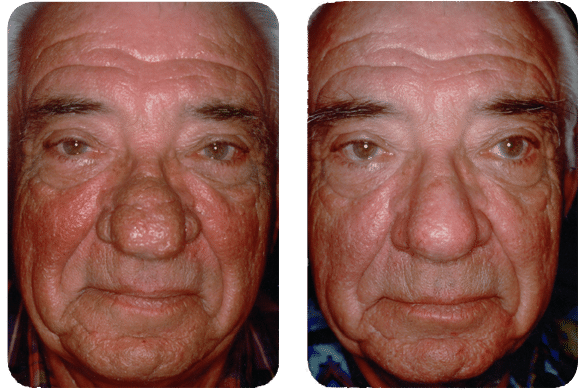 male before and after Rhinophyma procedure