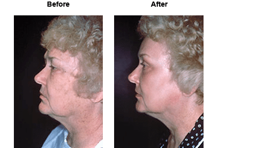 Female patient before and after laser resurfacing #1