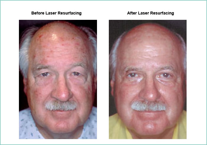 Male patient before and after laser resurfacing