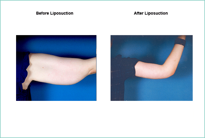 Liposuction Before and After #11