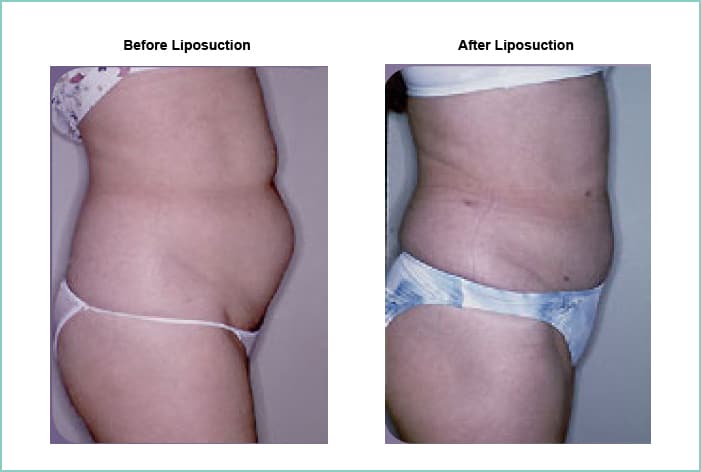Liposuction Before and After #1