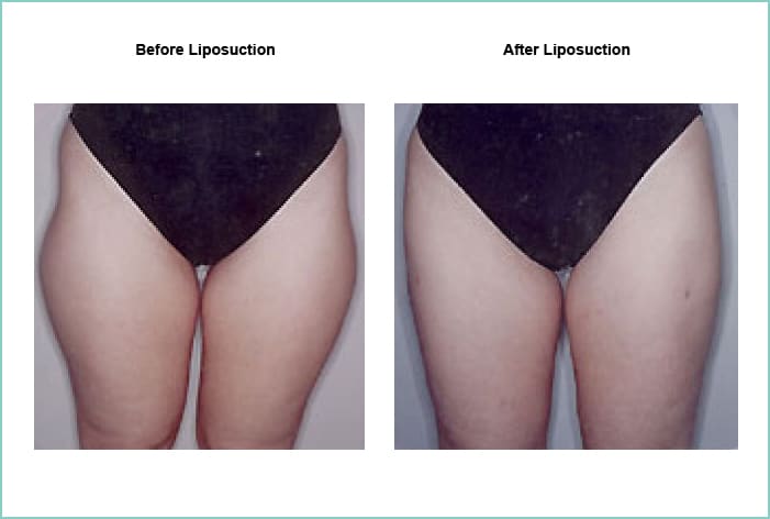Liposuction Before and After #4